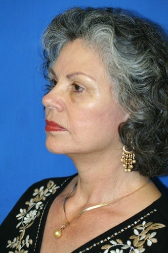 Facelift after 138675