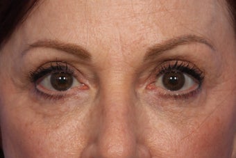 Restylane after 309247