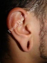 Earlobe Repair Surgery before 612296