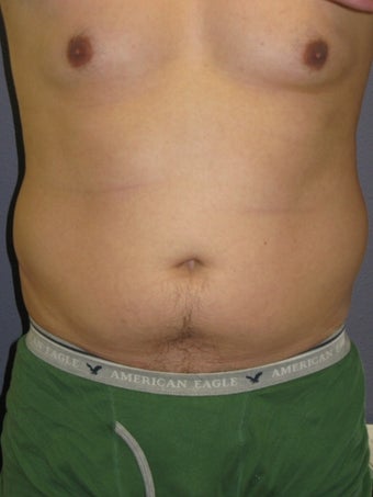 Liposuction Male before 575522