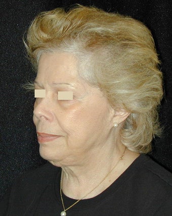 Facelift / Necklift before 103845