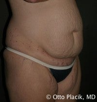 Abdominoplasty before 565832