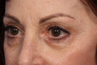 Restylane before 309248
