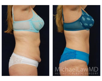 Abdominoplasty - Tummy Tuck 629026