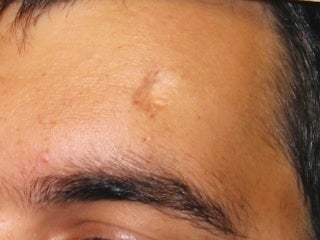 Severe, Deep Scars with Pixel before 272103