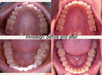 Invisalign before 145679