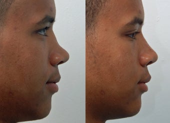 Rhinoplasty before 225886