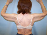 Arm Lift Surgery before 133861