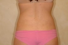 Liposuction after 177562