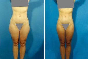 Liposuction before 636231