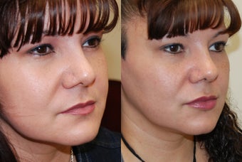 Lip Augmentation with Silikon-1000 before 351132
