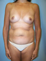 Tummy Tuck Surgery (abdominoplasty) and Breast Implants before 143850