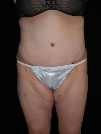 Tummy tuck (abdominoplasty) after 223315