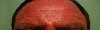 BOTOX in the forehead before 343351
