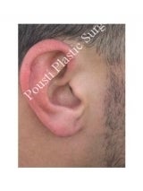 Earlobe Repair Surgery after 612296