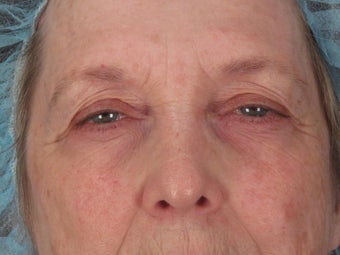 Eyelid Surgery before 324141