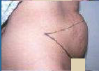 Abdominoplasty 67003