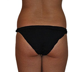 Butt Augmentation (Implants) before 550251