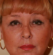 blepharoplasty (eyelids) after 219354
