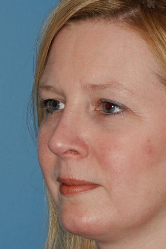 Revision Rhinoplasty after 81103
