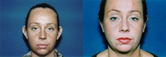 Otoplasty before 633526