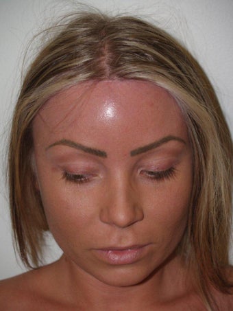 Surgical Hairline Advancement Procedure after 535779