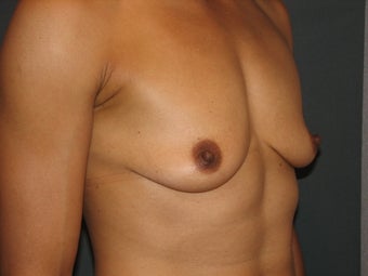 Bilateral Breast Augmentation with Silicone Gel Implants 472900