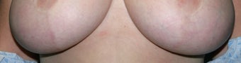 Laser treatment for breast implant scars after 376107