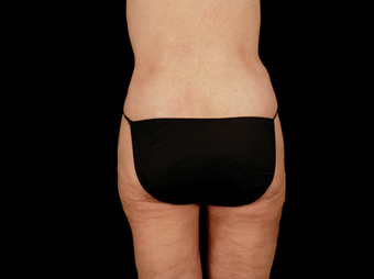 Lift of Thighs, Hips, and Butt after 230714