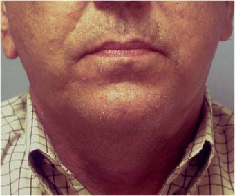 Lower face and necklift after 255548