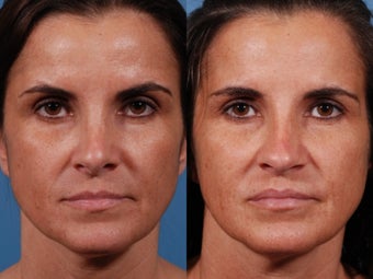 Revision rhinoplasty before 435954