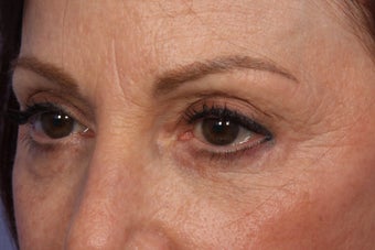 Restylane after 309248