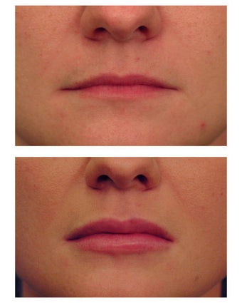 Juvederm before 301132