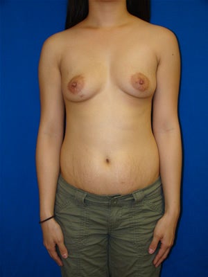 Breast Augmentation Surgery before 142017