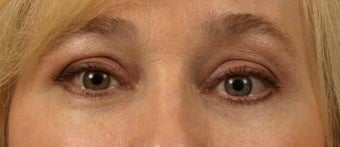 Lower Eyelid/Tear-Trough Restyalne after 467136