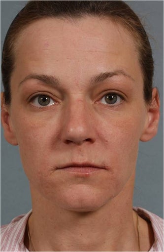 41 Year Old Female Treated for sun damage, wrinkles, and acne scars before 645384