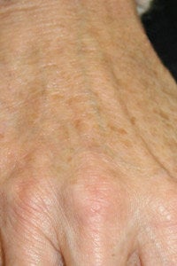 Radiesse hand injection after 255552