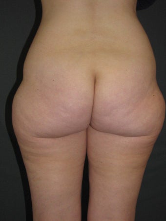 Smart Lipo of Hips, Saddle Bags, and Inner Thighs 325110