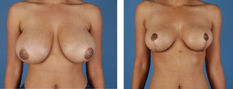 Breast Reduction before 355740