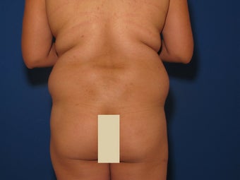 Brazilian Butt Lift before 124646
