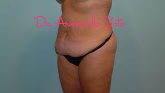 Body Lift after Large Weight Loss before 534126