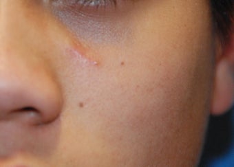 Mole removal after 199338