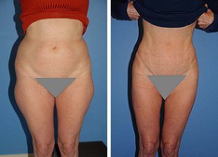 Liposuction before 636190