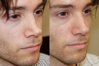 Non-Surgical Rhinoplasty with Silikon-1000 for permanent results. before 216826