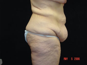 Body Lift, Outer Thigh Lift, Buttocks Lift before 203465