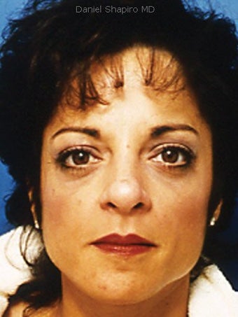 Upper and Lower Blepharoplasty after 249789