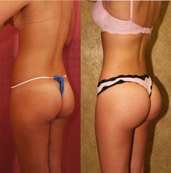 Brazilian Butt Lift 637891
