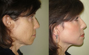 Small Image Lift, Full Face Laser Resurfacing after 351058