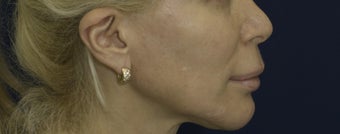 Lip Lift 606645