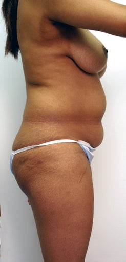 Liposuction with fat grafting / transfer to buttocks before 535831